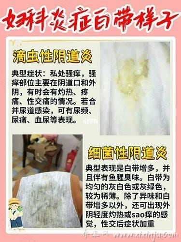  白带像豆腐渣怎么回事用什么药