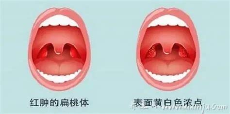 怀孕了扁桃体发炎怎么办