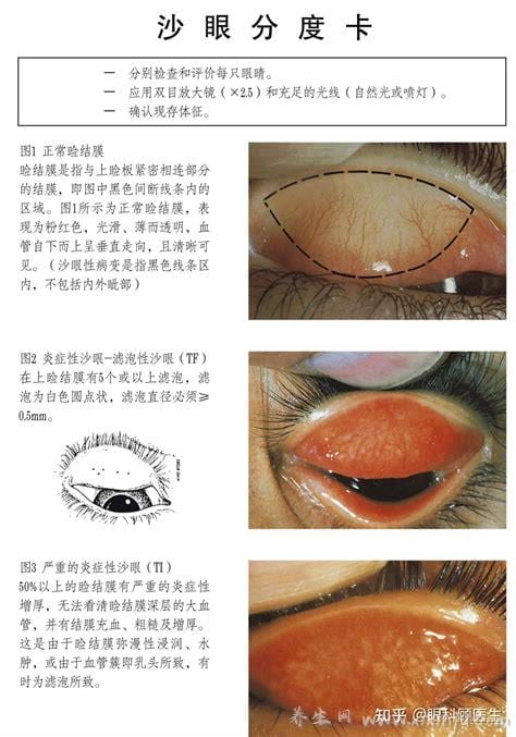  沙眼怎么引起的