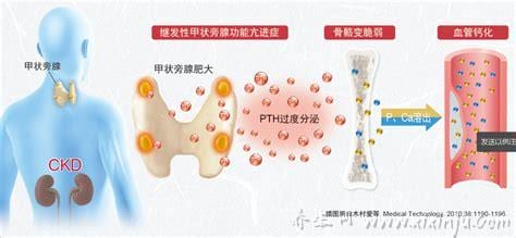 甲状旁腺功能亢进是什么