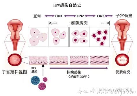  宫颈癌的具体症状都有哪些