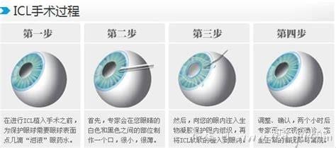 近视眼手术的利弊