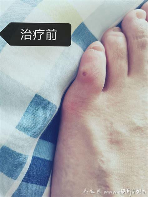  长鸡眼怎么办