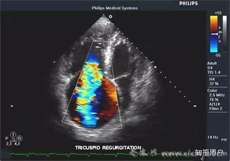  心脏彩超fs的意义