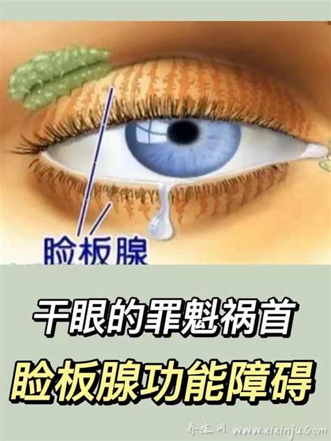 睑板腺功能障碍到底可以治愈吗