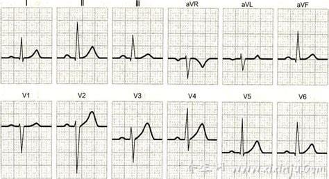 心电图正常值范围