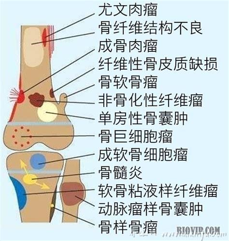  骨肉瘤病因