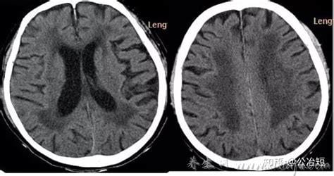 脑白质疏松是什么病