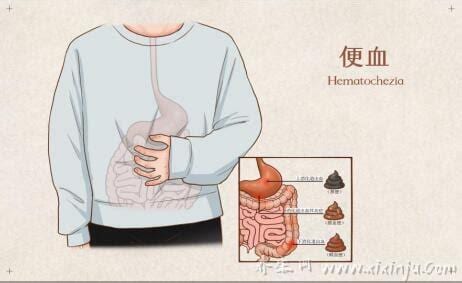  便血是怎么回事