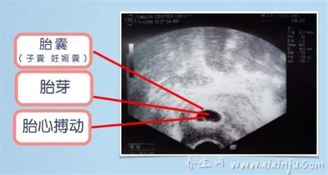 宫内妊娠是什么意思