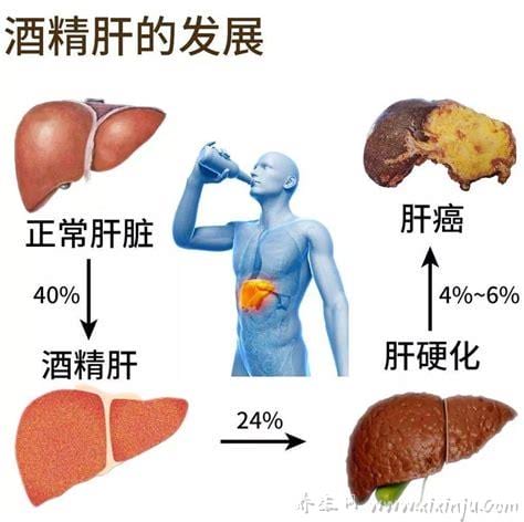  酒精肝怎么治