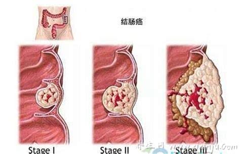 结肠癌的早期症状及表现