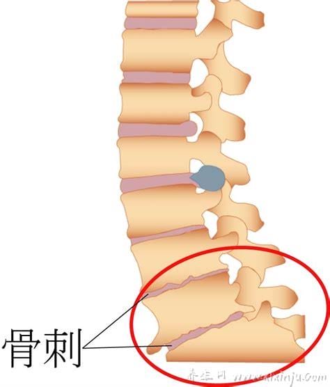  腰椎轻度骨质增生怎么办