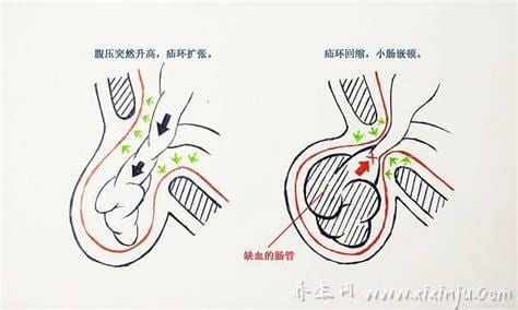  小儿疝气的症状表现