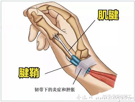  腱鞘囊肿怎么引起的