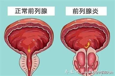  慢性前列腺炎怎么治疗