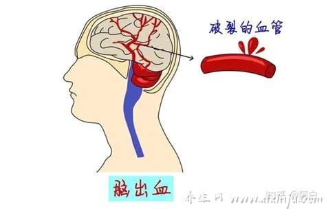 突发脑溢血怎么办