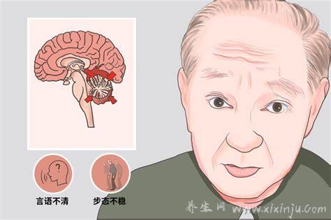 小脑萎缩一般能活几年