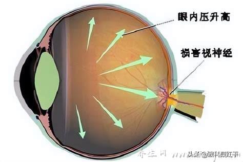  眼压高是怎么回事