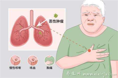  肺癌的症状和前兆