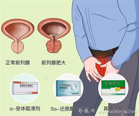 前列腺结石需要治疗吗