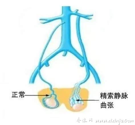 左侧精索静脉曲张是怎么引起的