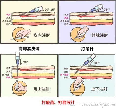 屁股针跟吊针的区别是什么