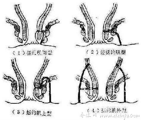 肛瘘不开刀四种方法