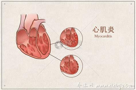 心肌炎的症状与表现