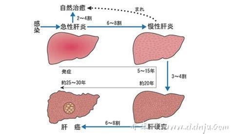 肝炎病症状