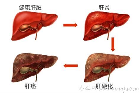 肝癌晚期会传染吗