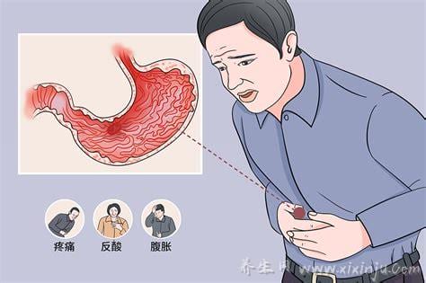  胃溃疡和十二指肠溃疡的区别