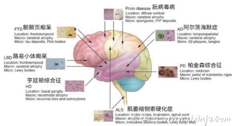 神经退行性疾病伴脑铁沉积6型是什么病