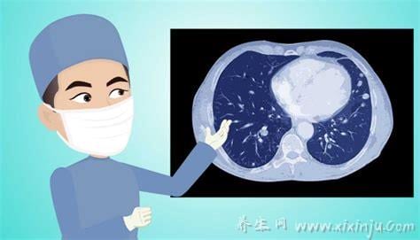 肺部磨玻璃结节意味着什么